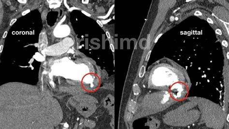 lv angiography|left ventricular pseudoaneurysm vs aneurysm.